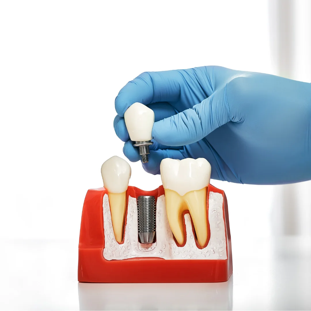 Dental implant