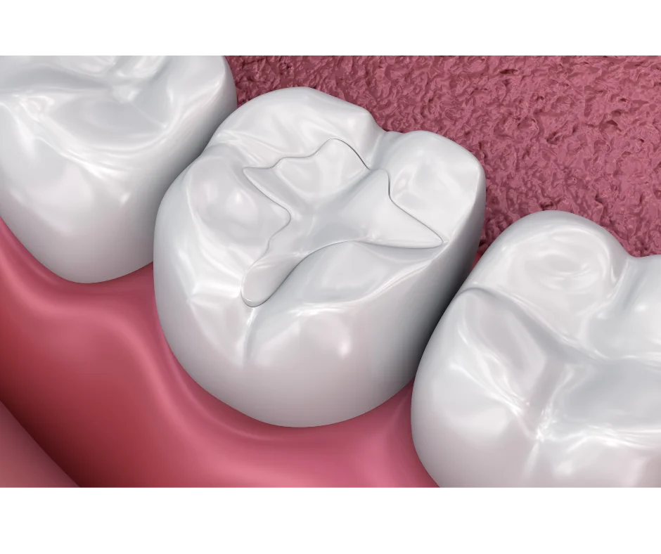 Composite dental bonding
