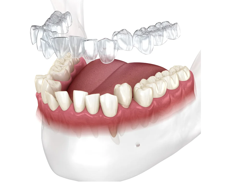 Invisalign clear aligner