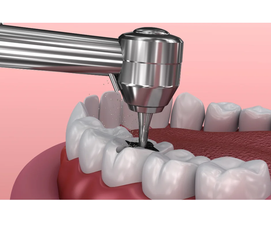 Root canal therapy