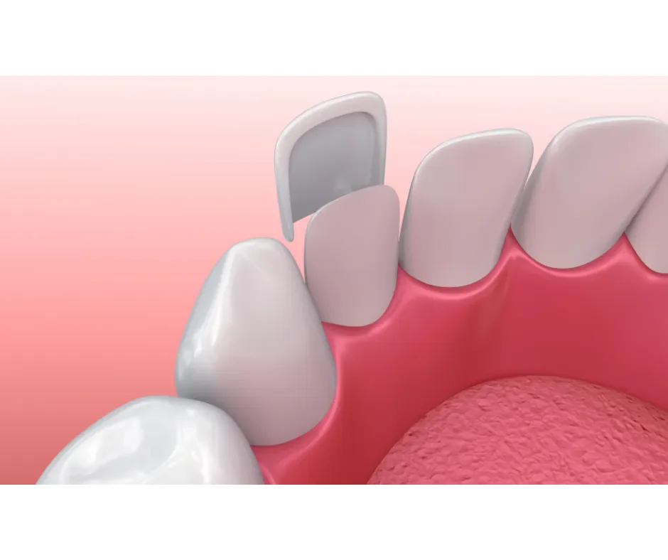 Cosmetic dentistry — veneers and smile design